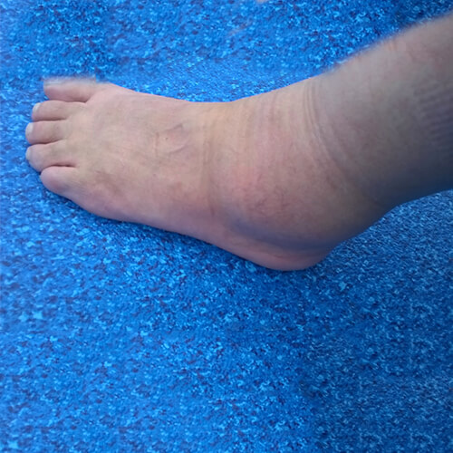 Swollen ankle and foot on a blue carpet